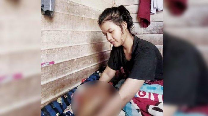 VIRAL ! Gadis Cantik Penderita Tumor Itu Warga Pekanbaru tapi Banyak Netizen di Tasikmalaya Bersimpati