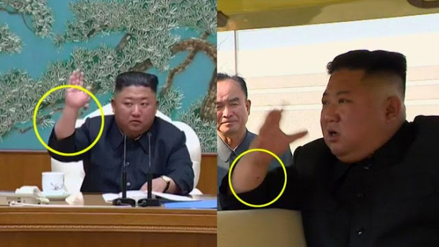 Misteri Bekas Operasi Kim Jong Un yang Masih Jadi Teka-teki