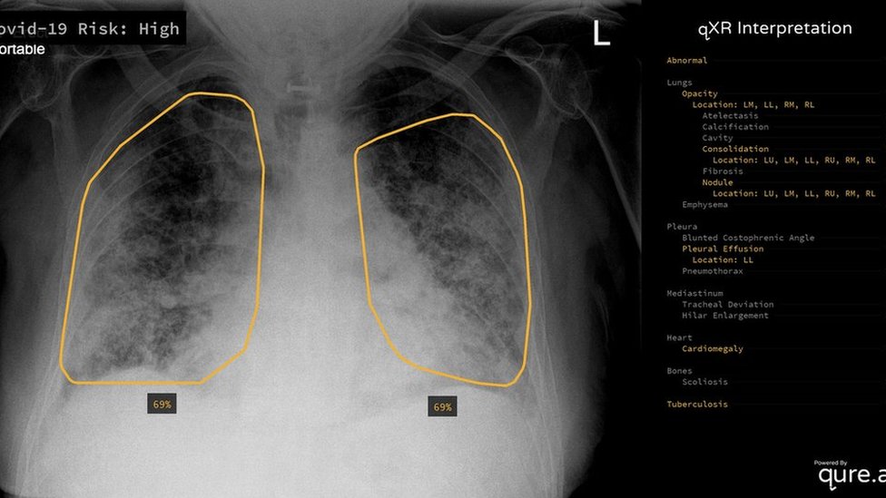Dokter China Periksa Paru-paru Pasien Corona dengan Kecerdasan Buatan