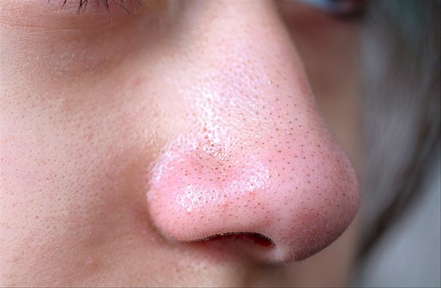 Berikut Beberapa Cara Menghilangkan Komedo Di Hidung