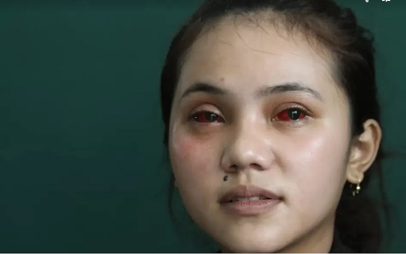 Mata Merah Korban Tragedi Kanjuruhan Disebut Dokter Spesialis Bisa Menyebabkan Cacat Permanen Yaitu Kebutaan 
