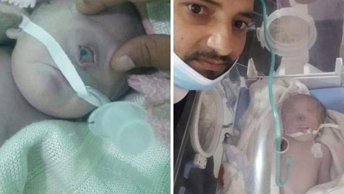VIRAL ! Bayi Bermata Satu Lahir di Al Bayda Yaman Disebut Cyclopia 