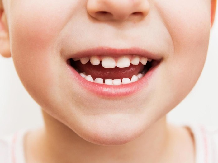 Berikut Penyebab Kerusakan Gigi pada Anak