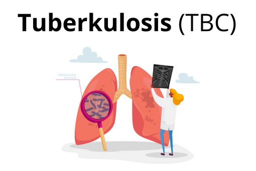 Kemenkes Sebut 800 Ribu Orang Indonesia Terkena TBC, Himbauan Pada Masyarakat