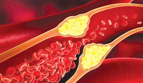 4 Tanda Umum Ini Kolesterol Sedang Mengendap di Dalam Tubuh