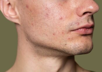 Masih Banyak yang Gak Tahu! Ini Penyebab Munculnya Jerawat di Muka