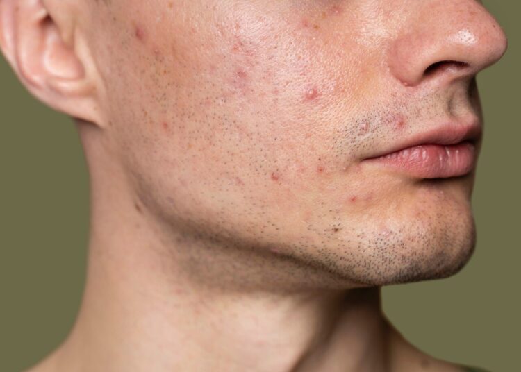 Masih Banyak yang Gak Tahu! Ini Penyebab Munculnya Jerawat di Muka