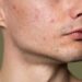 Masih Banyak yang Gak Tahu! Ini Penyebab Munculnya Jerawat di Muka