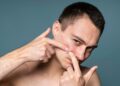 Cek Tips Menghilangkan Bekas Jerawat yang Jarang Diketahui, Apa Saja?