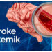 Ini Gejala Umum dan Penanganan Cepat Stroke Iskemik
