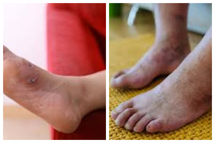 Tips Merawat Luka Diabetes untuk Menghindari Komplikasi Serius