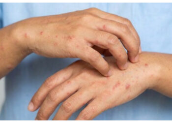 Jangan Salah Kaprah, Ini Perbedaan Ruam Kulit Biasa dan HIV!