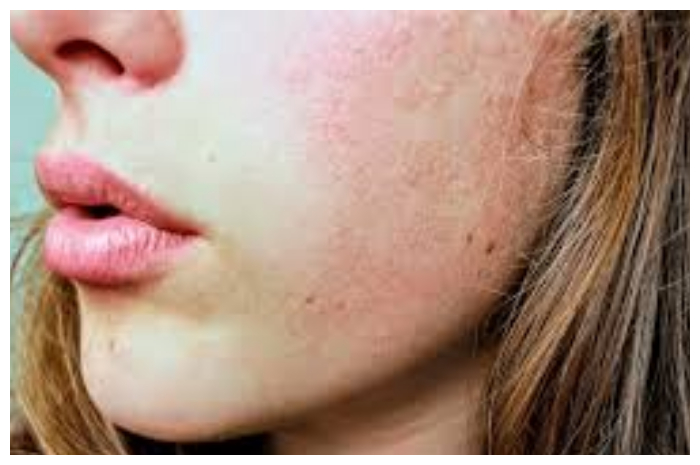 Jangan Salah Kaprah, Ini Bedanya Kulit Kering dan Kulit Dehidrasi