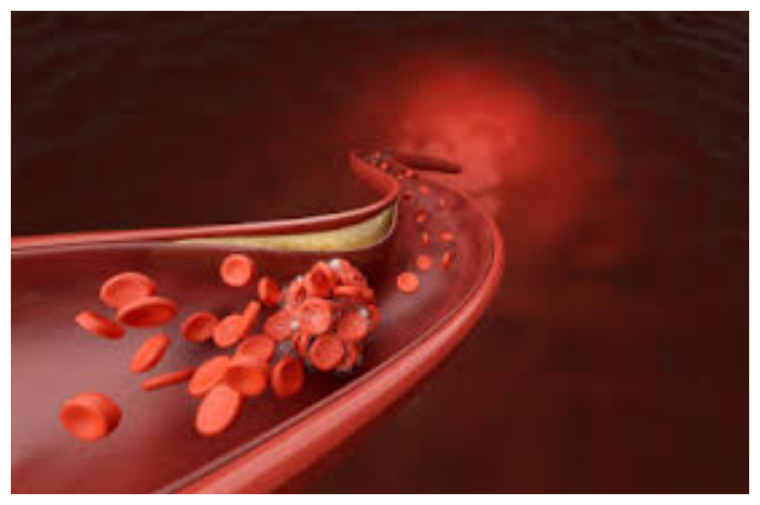 Kolesterol dan Trigliserida Tinggi, Waspadai Hiperlipidemia