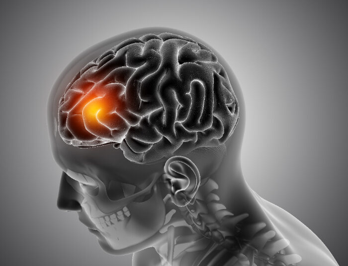 Awas! Ini Tanda-Tanda Stroke yang Perlu Anda ketahui, Apa Saja?