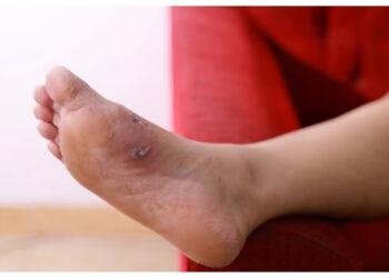 Jangan Diabaikan! Ini Gejala Kaki Diabetes yang Bisa Berujung Amputasi