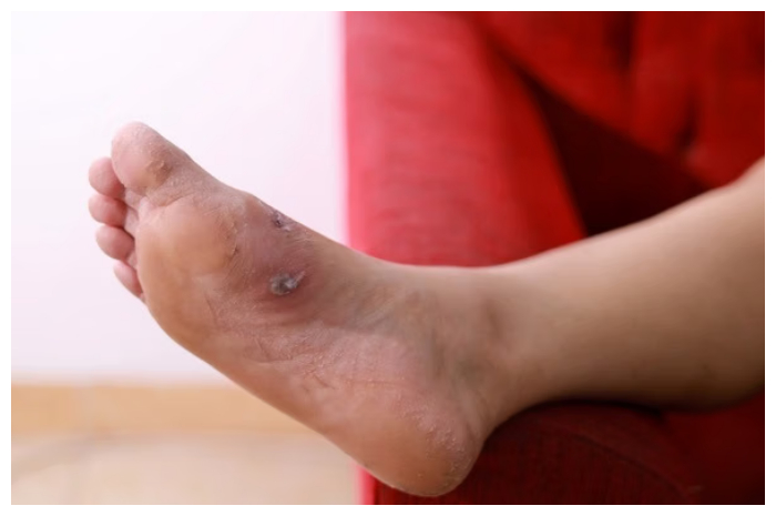 Jangan Diabaikan! Ini Gejala Kaki Diabetes yang Bisa Berujung Amputasi