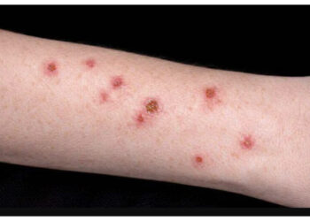 Waspada! Ini Tanda-Tanda Darah Manis yang Perlu Diketahui