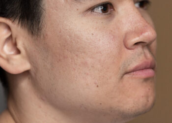 Cara Menghilangkan Flek Hitam di Wajah, yang Mau Glow Up Wajib Tahu!