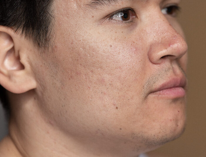 Cara Menghilangkan Flek Hitam di Wajah, yang Mau Glow Up Wajib Tahu!