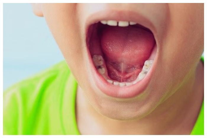 Gigi Berlubang Bisa Ganggu Tumbuh Kembang Anak, Ini Dampaknya