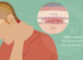 Jangan Abaikan! Kebiasaan Sehari-hari Ini Bisa Picu Meningitis