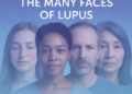 Mengenal Lupus, Penyakit Autoimun yang Berjuluk “Penyakit Seribu Wajah”