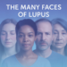 Mengenal Lupus, Penyakit Autoimun yang Berjuluk "Penyakit Seribu Wajah" 9 Mengenal Lupus, Penyakit Autoimun yang Berjuluk “Penyakit Seribu Wajah”